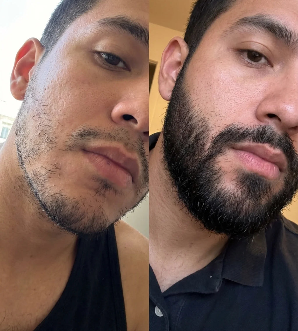APOLO Minoxidil 20%